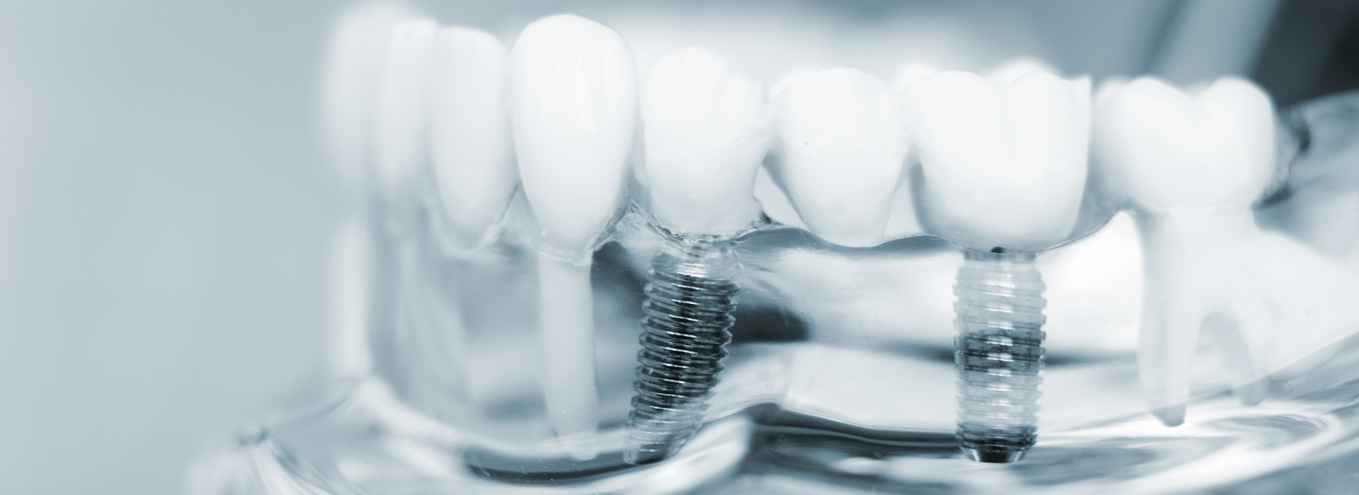 Armitage Oral Surgery | Zygomatic Dental Implants, Full Arch Restoration  All-on-X  and Dental Implant Placement